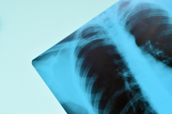 Medical Examination for Canada Chest X-ray